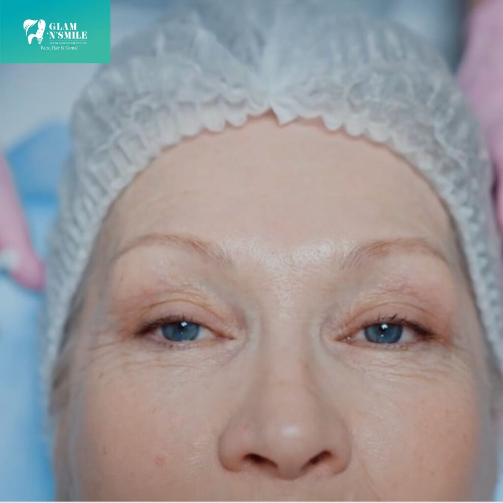 Botox Facial Treament