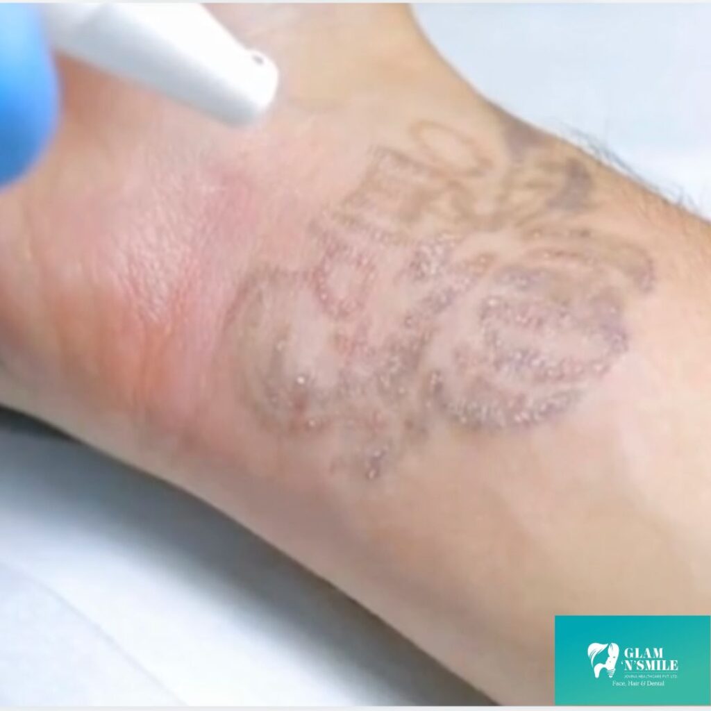 Tattoo Removal