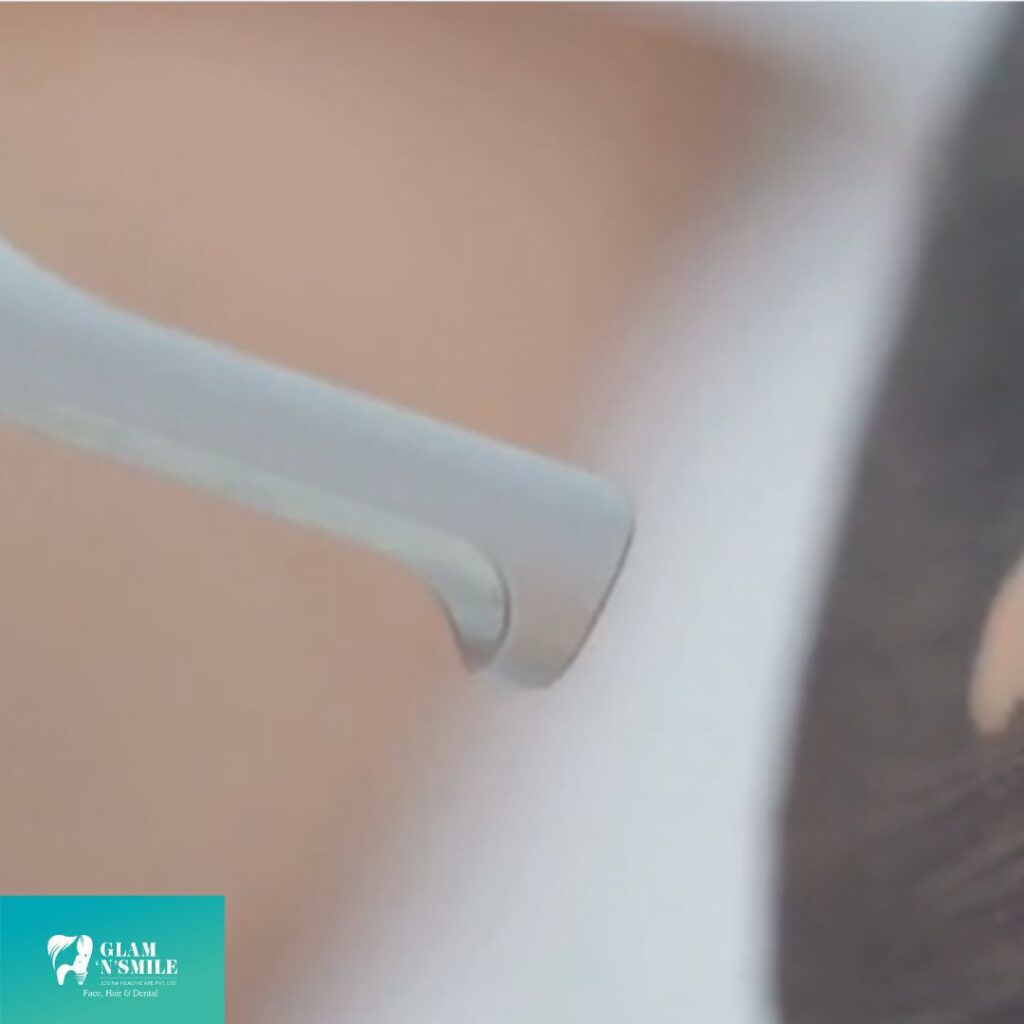 Carbon Laser Peel facial treatment