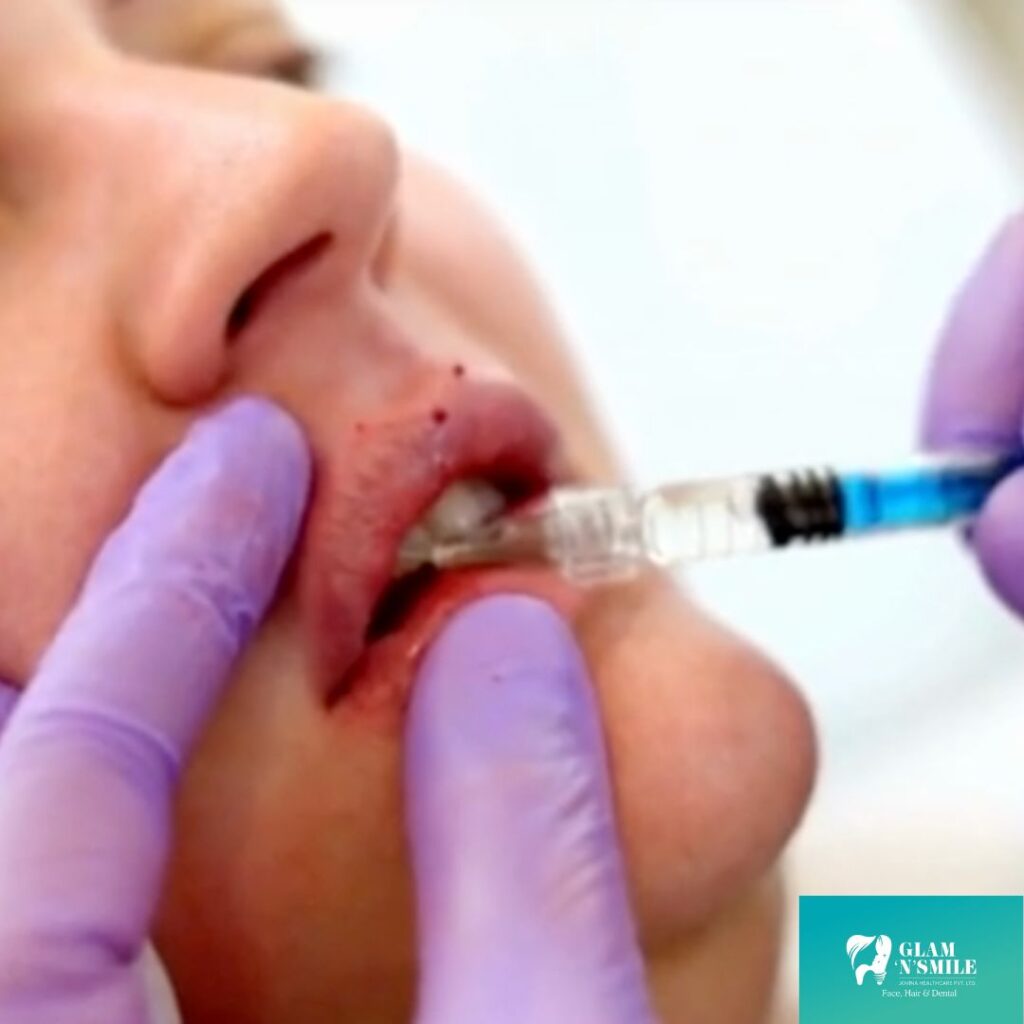 Dermal Fillers Facial treatment