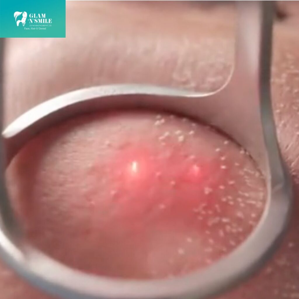 Laser Toning Facial Tratment