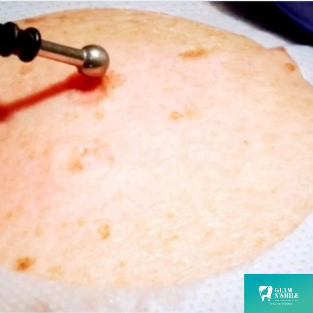 Mole Removal Facial Tratment