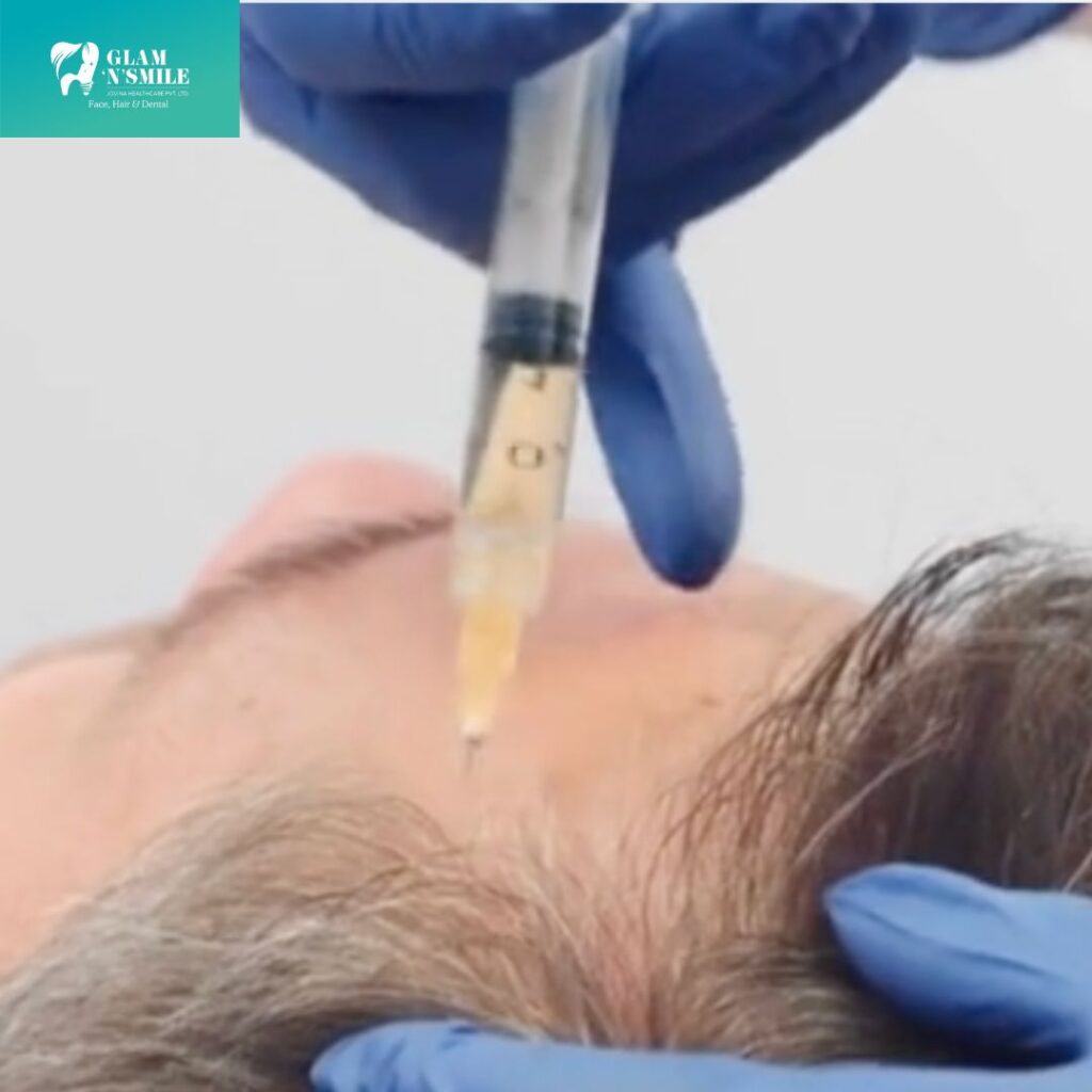 Platelet-rich plasma (PRP) for Hair growth