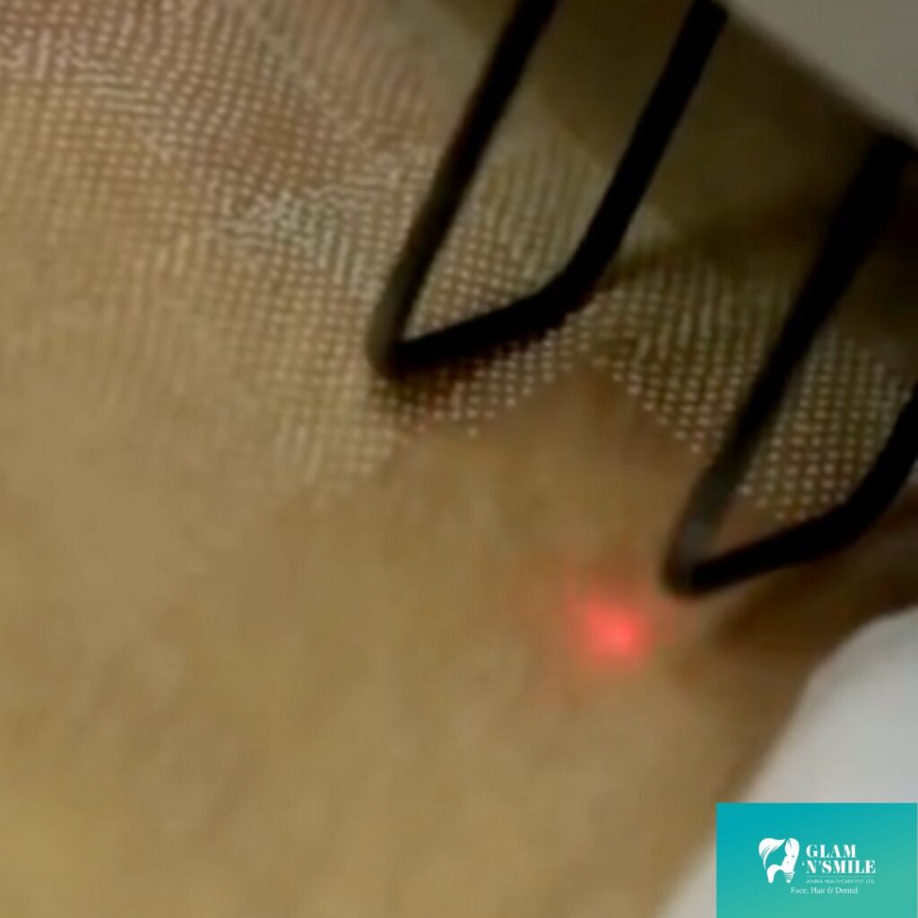 Stretch Mark Removal