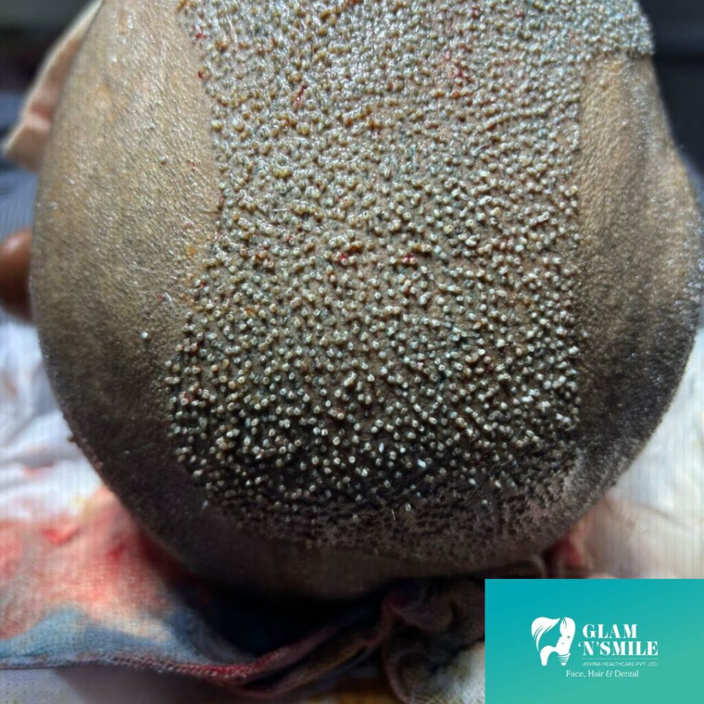 Hair Transplant