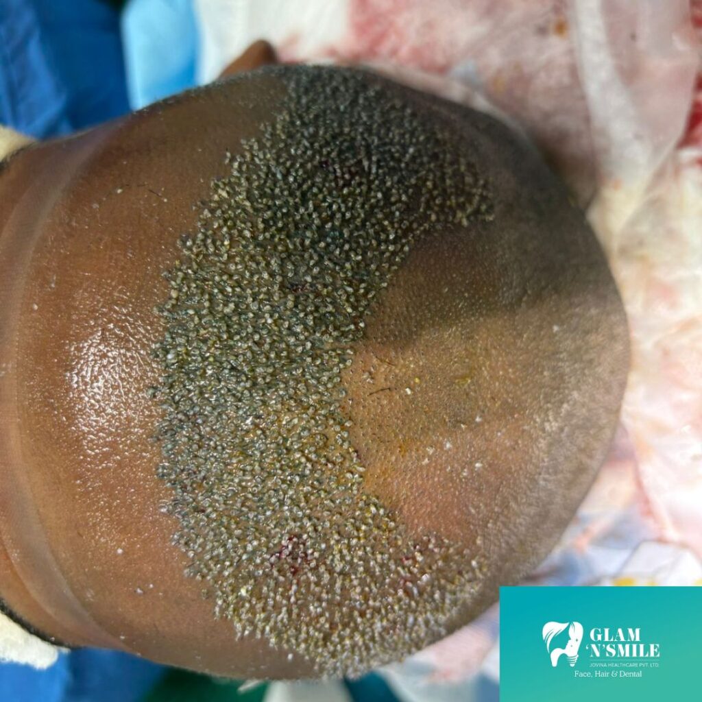 Hair Transplant