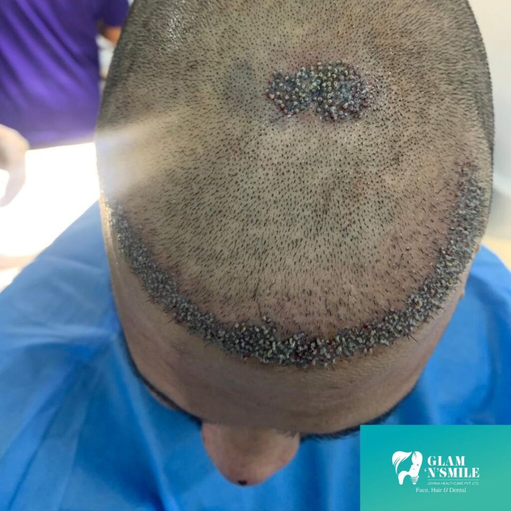 Hair Transplant